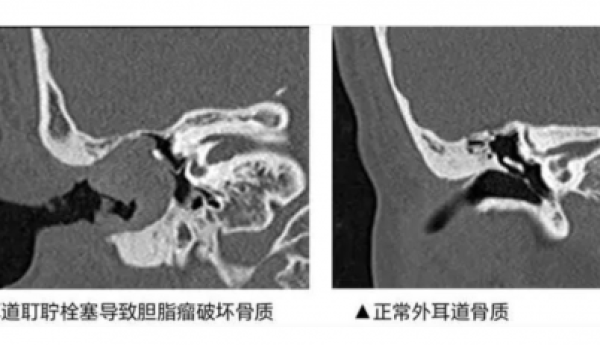 医疗级认证，bebird蜂鸟可视耳勺耳道健康的守护者