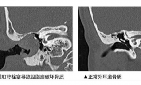 医疗级认证，bebird蜂鸟可视耳勺耳道健康的守护者